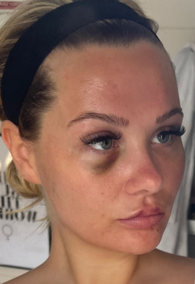 Love Island’s Shaughna shares shocking picture of herself with a black eye