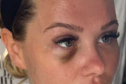 Love Island’s Shaughna shares shocking picture of herself with a black eye
