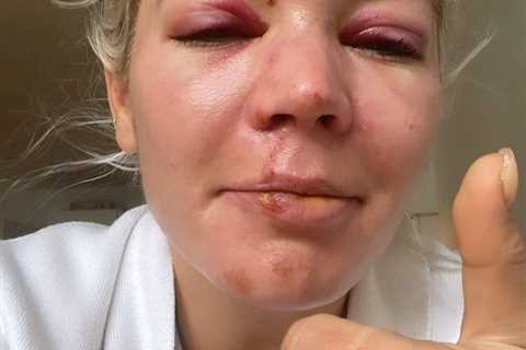 Danni Menzies reveals she’s still suffering from vertigo six months after horror moped smash