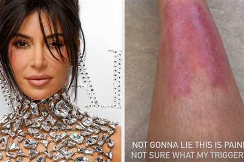 Kim Kardashian Is Being Praised For Her “Vulnerability” After She Shared New Videos Of A Psoriasis..