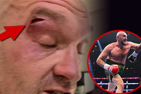 Tyson Fury Pulls Out Of Usyk Fight After Suffering Gnarly Cut While Sparring