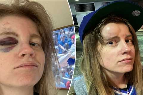Blue Jays fan shows the grisly impact of getting hit by a 110-mph Bo Bichette foul ball