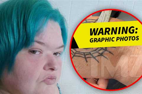 First Look at '1000-Lb. Sisters' Star Amy Slaton's Wound From 'Camel Bite'
