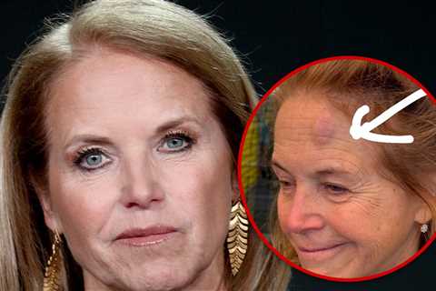 Katie Couric Debuts Nasty Forehead Bruise After Pickleball Accident