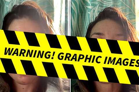 Evangeline Lilly Reveals Gruesome Facial Injury After Fainting on Beach