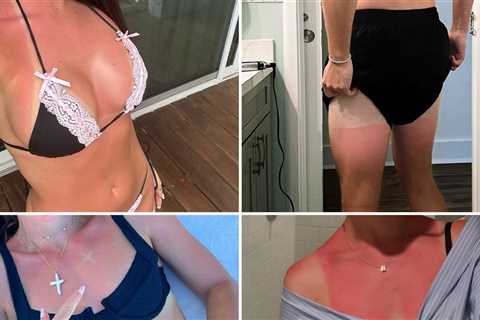 Celebrity Sunburns Guess Who ... Lay Off The (Vitamin) D!