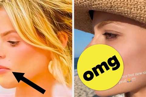 Fans Are Saying Brooks Nader Looks “So Much Younger” After Getting Her Lip Filler Dissolved — And..