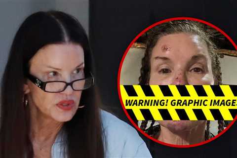 Janice Dickinson Spotted After Sharing Alleged Injuries From Reality Show Fall